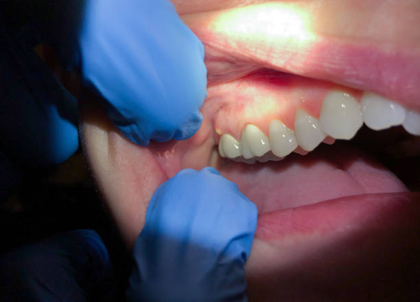 Best Broken Tooth Emergency  in Canterwood, WA